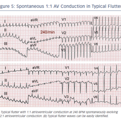 Figure 5 Spontaneous 11 AV Conduction in Typical Flutter