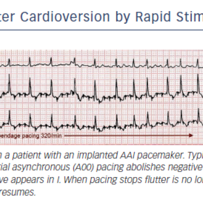 Figure 6 Flutter Cardioversion by Rapid Stimulation