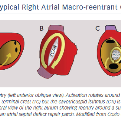 Figure 7 Atypical Right Atrial Macro-reentrant Circuits