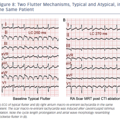 Figure 8 Two Flutter Mechanisms Typical and Atypical in the Same Patient