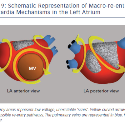 Figure 9 Schematic Representation of Macro-re-entrant Tachycardia Mechanisms in the Left Atrium