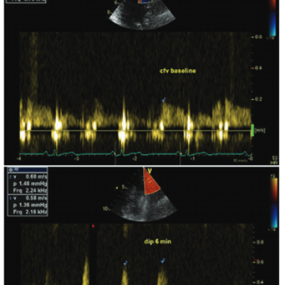 CFVR Assessment During Dipyridamole Stress Echocardiography. Coronary Flow Velocity is Measured at Baseline and at Peak Hyperaemia Sixth Minute of Dipyridamole Infusion