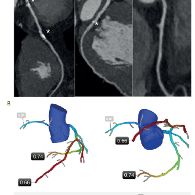 Figure 1 Example Case of Coronary Computed Tomography Angiography CCTA a 69-year-old Caucasian Man with Exertional Angina who Underwent CCTA