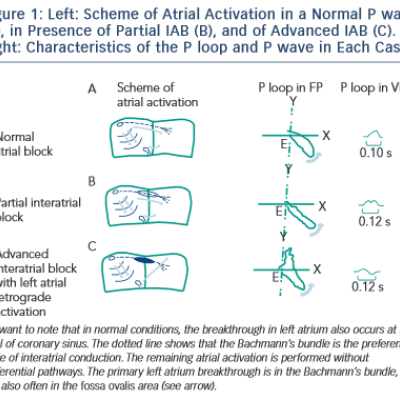Figure 1 Left Scheme of Atrial Activation in a Normal P wave A in Presence of Partial IAB B and of Advanced IAB C. Right Characteristics of the P loop and P wave in Each Case