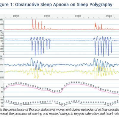 Obstructive Sleep Apnoea on Sleep Polygraphy