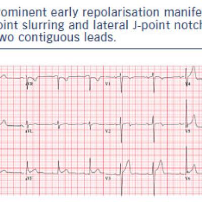 Prominent early repolarisation manifest as inferior J-point slurring and lateral J-point notching each &ampgt2 mm in two contiguous leads.