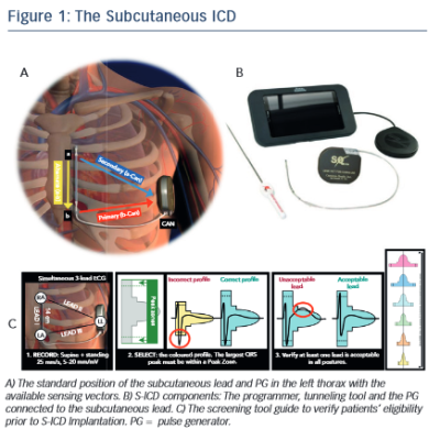 The Subcutaneous ICD