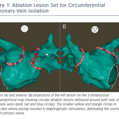 Figure 1 Ablation Lesion Set for Circumferential Pulmonary Vein Isolation