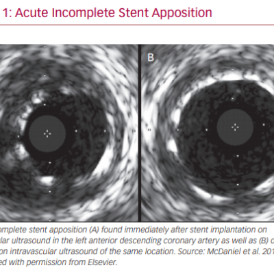 Acute Incomplete Stent Apposition