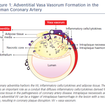 Figure 1 Adventitial Vasa Vasorum Formation in the Human Coronary Artery
