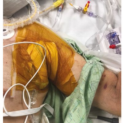 Figure 1 Ambulatory Patient with Left Axillary Artery IABP Inserted in the Cardiac Catheterisation Laboratory Awaiting Heart Transplantation and Able to Participate in Physical Therapy