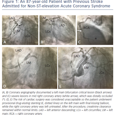 Figure 1 An 87-year-old Patient with Previous Stroke Admitted for Non-ST-elevation Acute Coronary Syndrome
