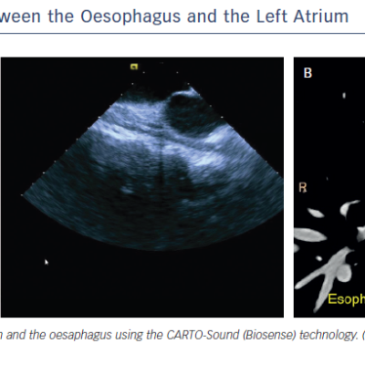 Figure 1 Anatomical Relationship Between the Oesophagus and the Left Atrium