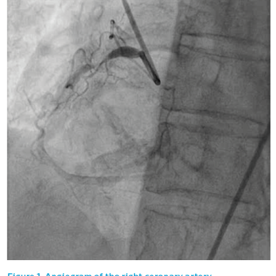 Figure 1. Angiogram of the right coronary artery