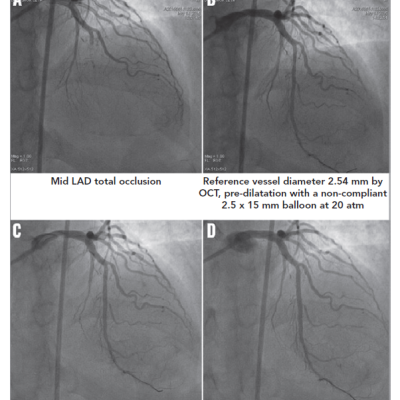 Figure 1 Angiographic Image of Mid LAD Lesion