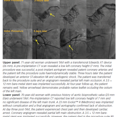 Figure 1 Angiographic Images of Two Delayed Coronary Obstruction Cases