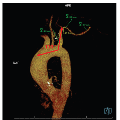 Angulation of Branch Vessel Entry to Aorta