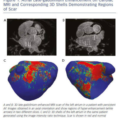 Figure 1 Atrial Late-gadolinium Enhancement on Cardiac MRI and Corresponding 3D Shells Demonstrating Regions of Scar