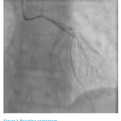 Figure 1. Baseline angiogram