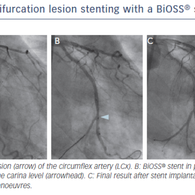 Figure 1 Bifurcation lesion stenting with a BiOSS® stent