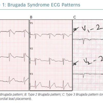 Brugada Syndrome ECG Patterns