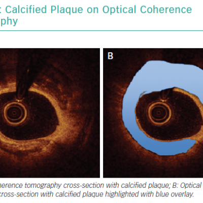Calcified Plaque on Optical Coherence Tomography