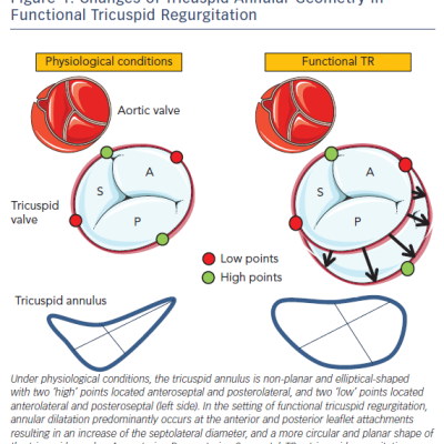 Figure 1 Changes of Tricuspid Annular Geometry in Functional Tricuspid Regurgitation