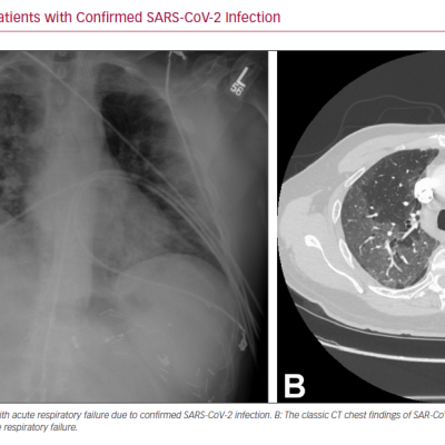 Chest Imaging of Patients with Confirmed SARS-CoV-2 Infection