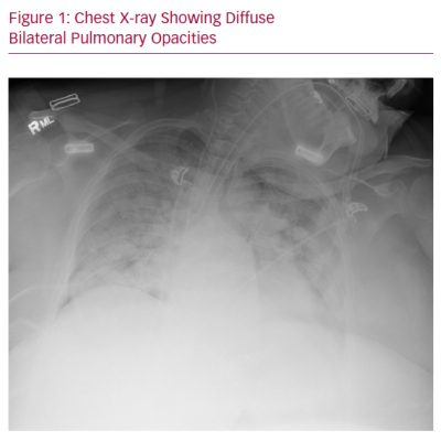 Chest X-ray Showing Diffuse Bilateral Pulmonary Opacities