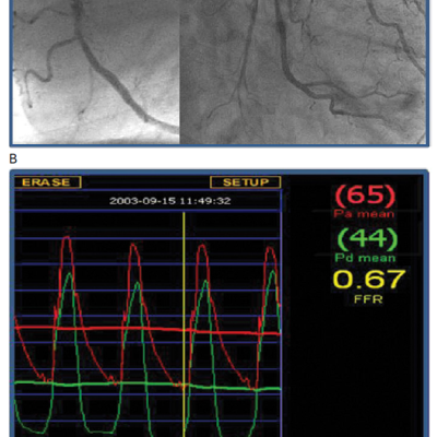 Figure 1 Coronary angiogram of right R and left L coronary artery CA together with FFR measurement of the L anterior descending artery LAD