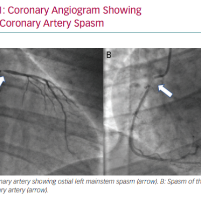 Coronary Angiogram Showing Severe Coronary Artery Spasm