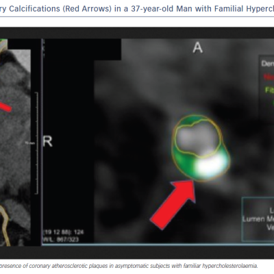 Figure 1 Coronary Artery Calcifications Red Arrows in a 37-year-old Man with Familial Hypercholesterolaemia