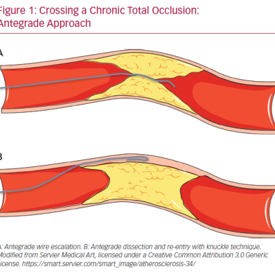 Crossing a Chronic Total Occlusion Antegrade Approach