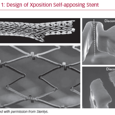 Design of Xposition Self-apposing Stent