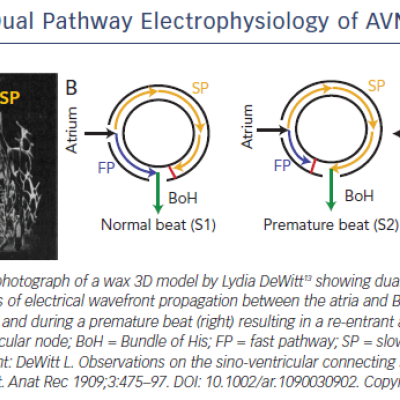 Figure 1 Dual Pathway Electrophysiology of AVN