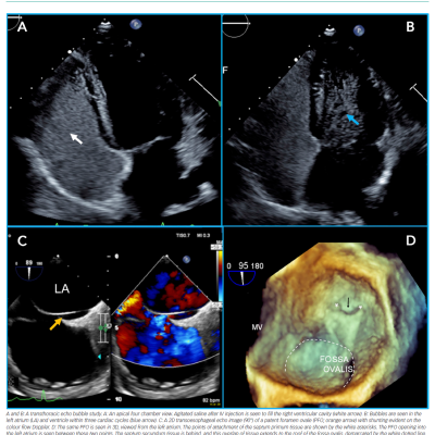Echocardiographic Assessment of a Patent Foramen Ovale