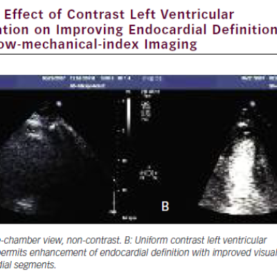 Effect of Contrast Left Ventricular Opacification