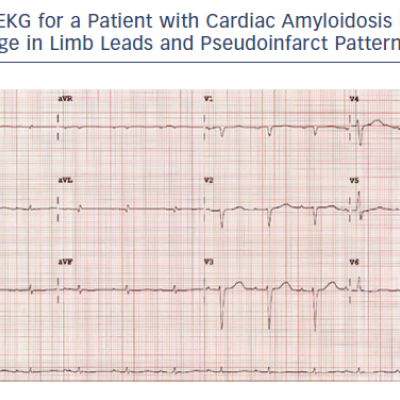 EKG for a Patient with Cardiac Amyloidosis Featuring Low Voltage in Limb Leads and Pseudoinfarct Pattern