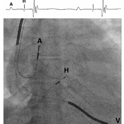 Figure 1 Electrical and Fluoroscopic Guidance for His Bundle Pacing