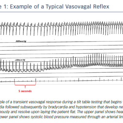 Figure 1 Example of a Typical Vasovagal Reflex