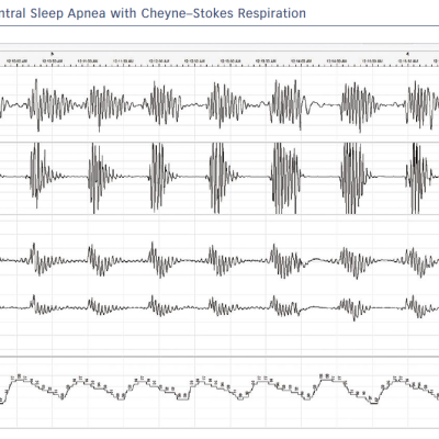 Figure 1 Example of Central Sleep Apnea with Cheyne–Stokes Respiration