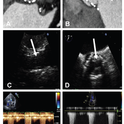 Figure 1 Example of Early Transcatheter Aortic Valve Thrombosis