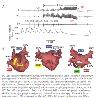 Figure 1 Identification of GP in the Electrophysiology Lab