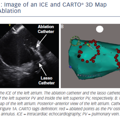 Figure 1 Image of an ICE and CARTO® 3D Map During Ablation