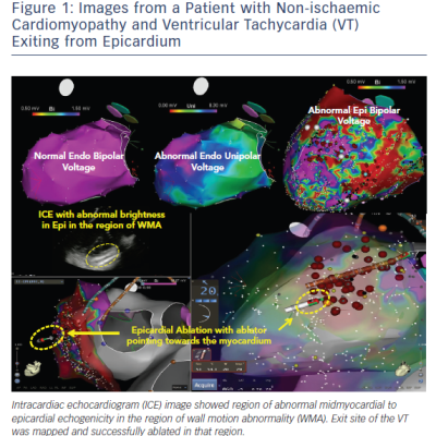 Patient with Non-ischaemic Cardiomyopathy &ampamp VT