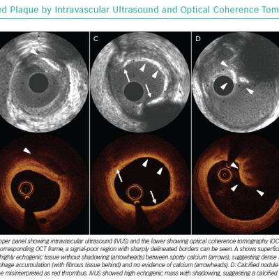 Images of Calcified Plaque by Intravascular Ultrasound and Optical Coherence Tomography