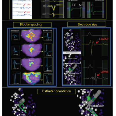 Impact of Orientation Size and Spacing on Bipolar Voltage Mapping