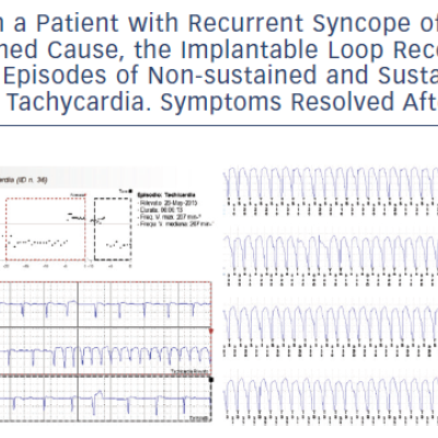 Figure 1 In A Patient With Recurrent Syncope Of Undetermined Cause The Implantable Loop Recorder Diagnosed Episodes Of Non-Sustained And Sustained Ventricular Tachycardia. Symptoms Resolved After Ablation