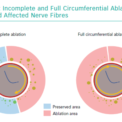 Incomplete and Full Circumferential Ablation Runs and Affected Nerve Fibres