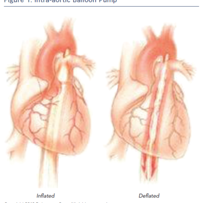Figure 1 Intra-aortic Balloon Pump